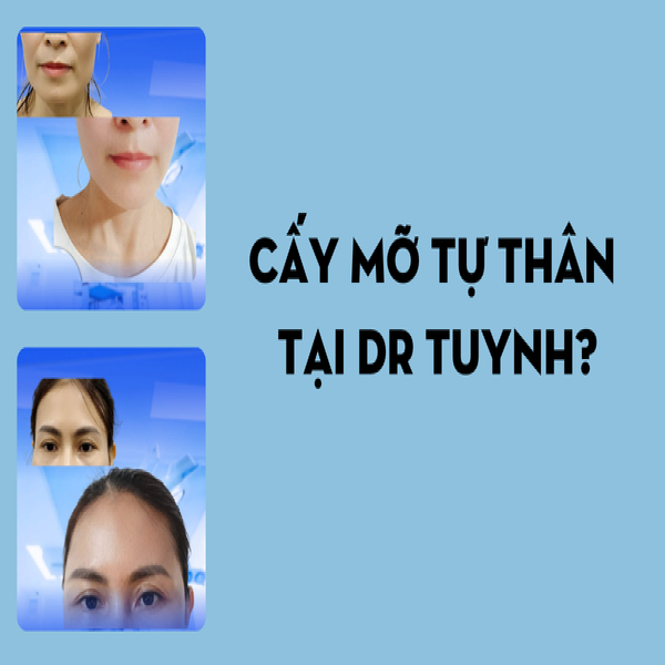 Cấy mỡ tự thân giữ được bao lâu? Giải đáp từ bác sĩ